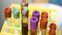 HbA1c Nedir, Kaç Olmalı? Üç Aylık Şeker Testi Hakkında Bilinmesi Gerekenler